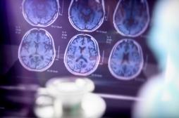 Voici pourquoi on compte peu de cancers chez les patients Alzheimer