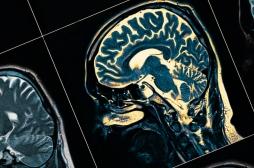 Schizophrénie : des rayons X pour analyser les neurones