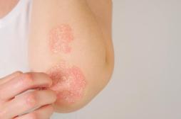 Biothérapies dans le psoriasis : peut-on réduire la posologie sans risque ?