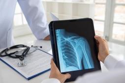 Ostéoporose : et si l’exposition aux PFAS y contribuait ? 
