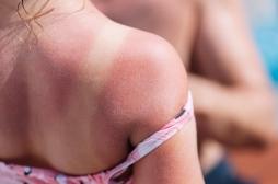 Coups de soleil : quels médicaments photosensibilisants peuvent augmenter le risque ? 