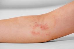 Épidermolyse bulleuse : le staphylocoque doré aggrave cette maladie chez les enfants