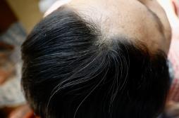 Chute de cheveux chez les femmes de 50 ans : principales causes et solutions 