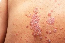 Psoriasis : l’incidence de la maladie va grimper jusqu’en 2050