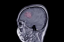 Progestatifs : une étude confirme un lien avec un risque accru de tumeurs au cerveau