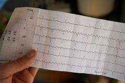 Fibrillation atriale : les battements cardiaques irréguliers 