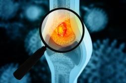 Cancer des os : ces 8 symptômes à ne pas négliger