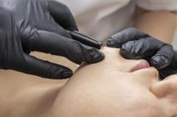 SMOP et électrolyse contre l'hirsutisme : 