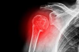Se casser l'épaule en tombant de sa hauteur peut être le signe d'une ostéoporose