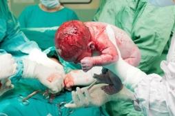 Césarienne: un coup de scalpel et 6 points de suture pour un nouveau-né 