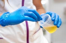 Un simple test urinaire pour dépister le cancer le plus meurtrier ?