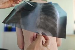 Tuberculose dans une école à Nîmes : comment prévenir la maladie ? 