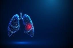 Cancer du poumon : ces infections courantes pourraient augmenter les risques
