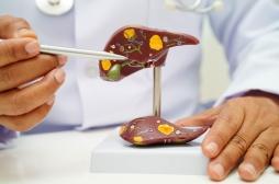 Qu’est-ce que le cancer du foie dont Thierry Ardisson est décédé ? 