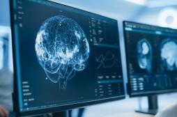 AVC : des chercheurs ont inversé les dommages cérébraux avec des cellules souches 