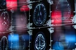 Parkinson : un virus longtemps jugé inoffensif pourrait être impliqué dans la maladie