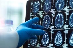 Troubles de la vision en avion : c’était une tumeur cérébrale