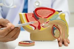 Ce phénomène qui explique comment le cancer de la prostate se développe 