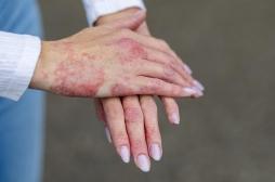 Eczéma : comment le stress déclenche les poussées ? 