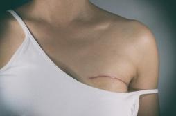 Cancer du sein : reconstruire le sein en se servant de la graisse de la patiente
