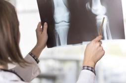 Arthrose du genou : les radios modifient la perception de la maladie et le choix du traitement
