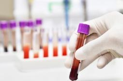 Cancer : une protéine dans le sang permet le diagnostic 7 ans avant les symptômes