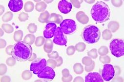 Traitements ciblés : comprendre leur impact sur les cellules de leucémie pour améliorer le traitement 