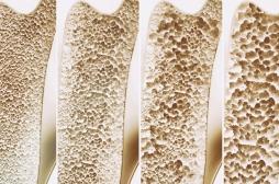 Ostéoporose : la douleur et la fatigue sont-elles révélatrices de la maladie ?