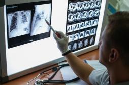 Cancer du poumon : un gène serait lié à la maladie 