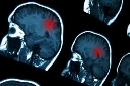 Cancer du cerveau : un nouveau médicament permettrait de traiter un glioblastome 