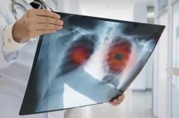 Cancer du poumon : les cas liés à la pollution augmentent
