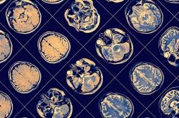 Parkinson : la protéine tau n'est pas en cause, contrairement à Alzheimer 