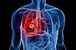 Cancer du poumon : quels sont les symptômes les plus courants ?