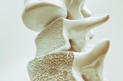 Ostéoporose : une nouvelle stratégie augmente de 800% la masse osseuse