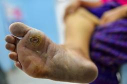 Diabète et problèmes de pied : un patch intelligent qui suit la cicatrisation des plaies à distance 