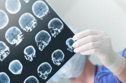 Épilepsie : la découverte de trois molécules donne l’espoir de nouveaux traitements 