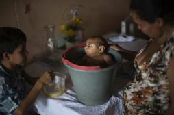Virus Zika : 3 000 cas de microcéphalie au Brésil
