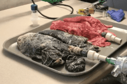 VIDEO. Une infirmière montre les poumons noircis d'un patient qui a fumé un paquet de cigarettes par jour pendant 20 ans