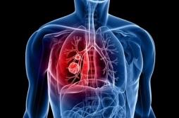 Cancer du poumon: l’association d’une immunothérapie à la chimiothérapie améliore la survie