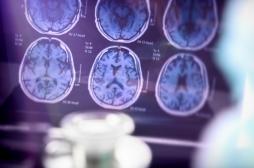 Alzheimer : la régulation du cuivre, une piste pour bloquer les pertes de mémoire