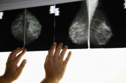 Cancer du sein : une thérapie ciblée allonge la survie 