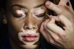 Vitiligo : un traitement révolutionnaire pour faire disparaître les tâches