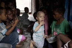 Mozambique : un jeune albinos massacré pour récupérer son cerveau 