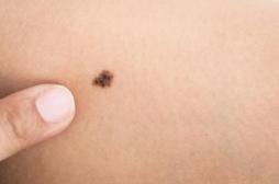 Cancer de la peau : les dermatologues proposent un dépistage gratuit en mai
