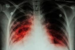 Tuberculose : dépistage dans sept écoles de la Vienne 