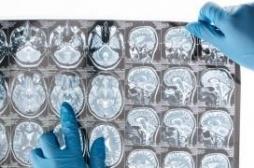 La protéine de la maladie d'Alzheimer se propagerait dans le cerveau comme une infection