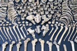Ostéoporose : l'épidémie silencieuse qui tue plus de 5000 femmes par an