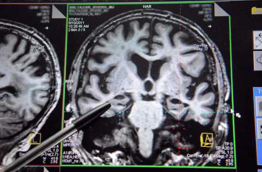 Alzheimer : des dépôts anormaux de graisse dans le cerveau 