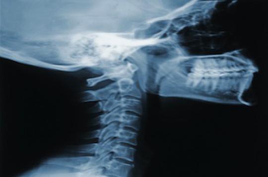 Ostéoporose : les associations réclament un dépistage systématique