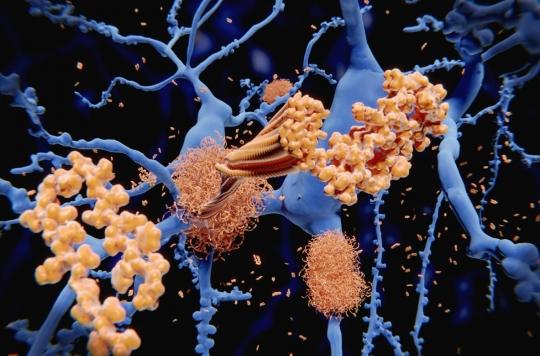 Alzheimer : les plaques bêta-amyloïdes protégeraient le cerveau au lieu de le détruire